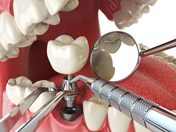 Best Emergency Tooth Extraction in Hancock, MI